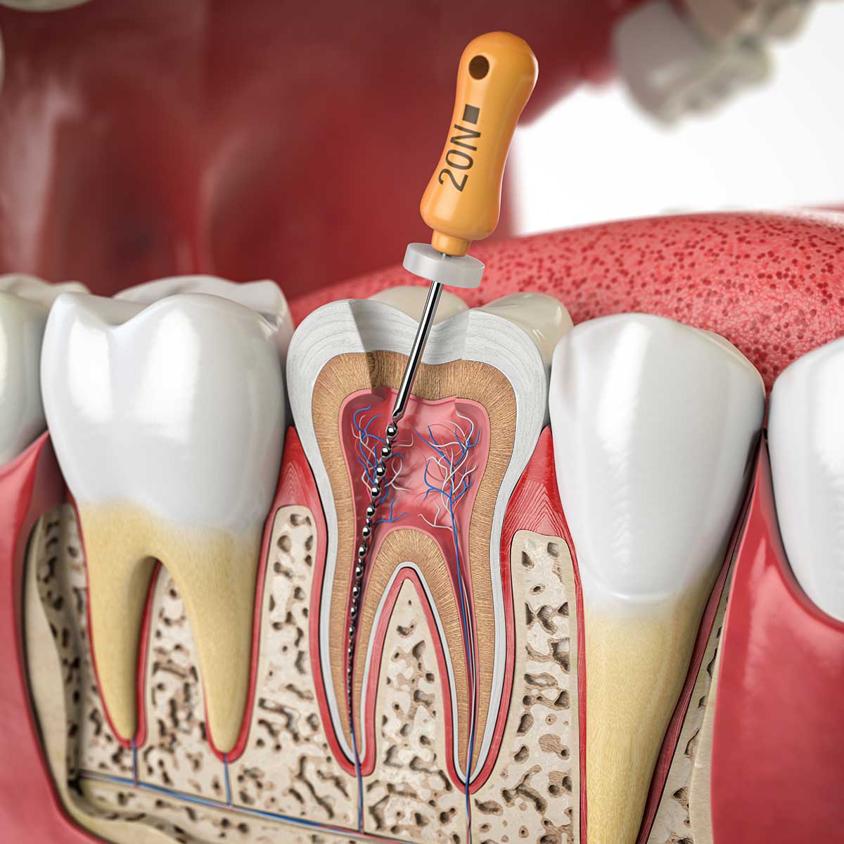 root canal therapy