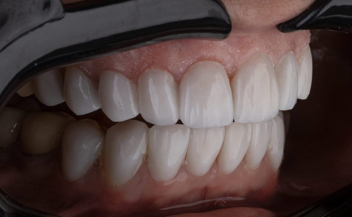 Veneers