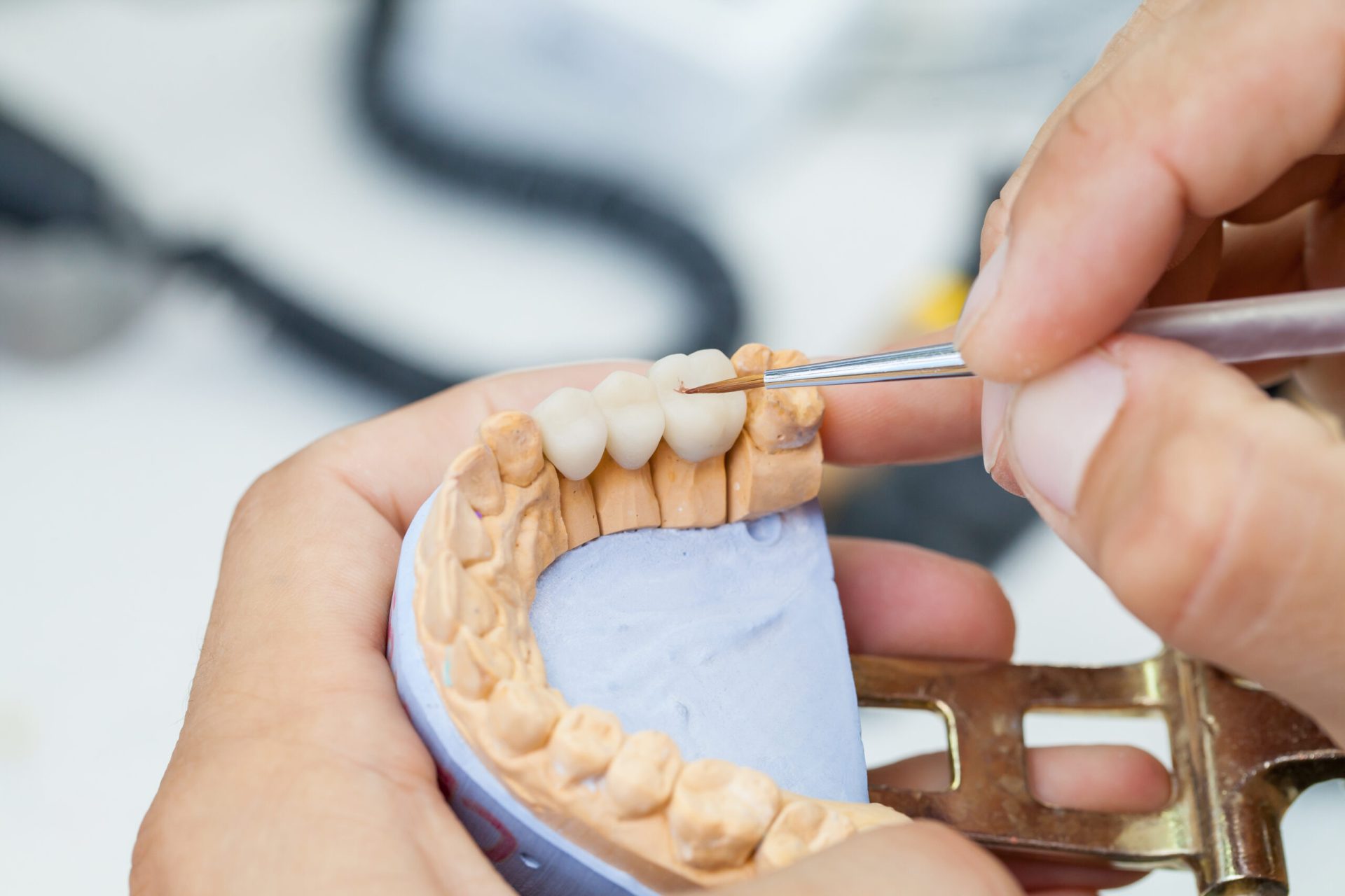 dental-bridge-aftercare-and-maintenance-scaled